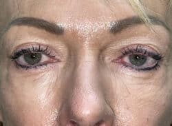 Combination Surgeries (eyelid lift and other)