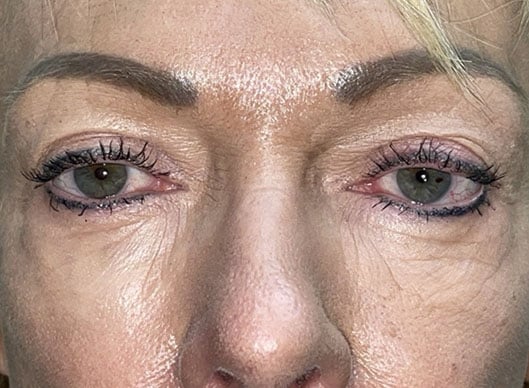 Combination Surgeries (eyelid lift and other)
