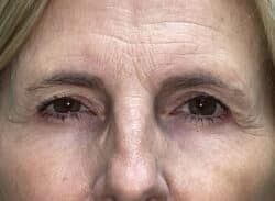 Combination Surgeries (eyelid lift and other)