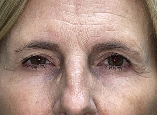 Combination Surgeries (eyelid lift and other)