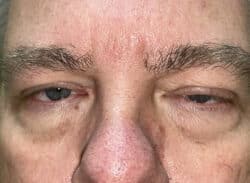 Combination Surgeries (eyelid lift and other)