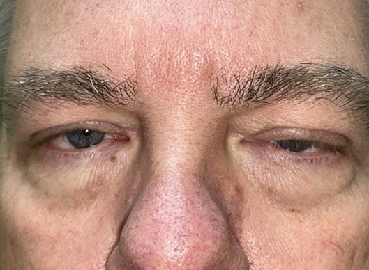 Combination Surgeries (eyelid lift and other)