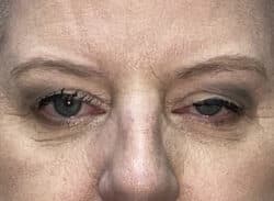 Combination Surgeries (eyelid lift and other)