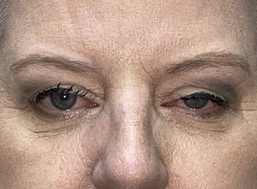 Combination Surgeries (eyelid lift and other)
