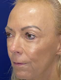 Combination Surgeries (eyelid lift and other)