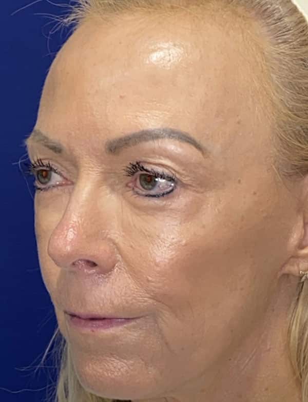 Combination Surgeries (eyelid lift and other)
