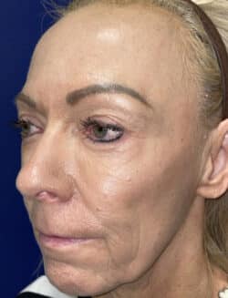 Combination Surgeries (eyelid lift and other)