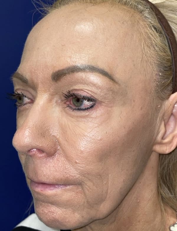 Combination Surgeries (eyelid lift and other)
