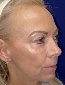 Combination Surgeries (eyelid lift and other)