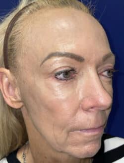 Combination Surgeries (eyelid lift and other)