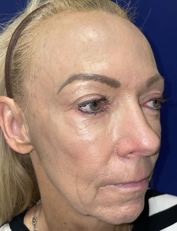 Combination Surgeries (eyelid lift and other)