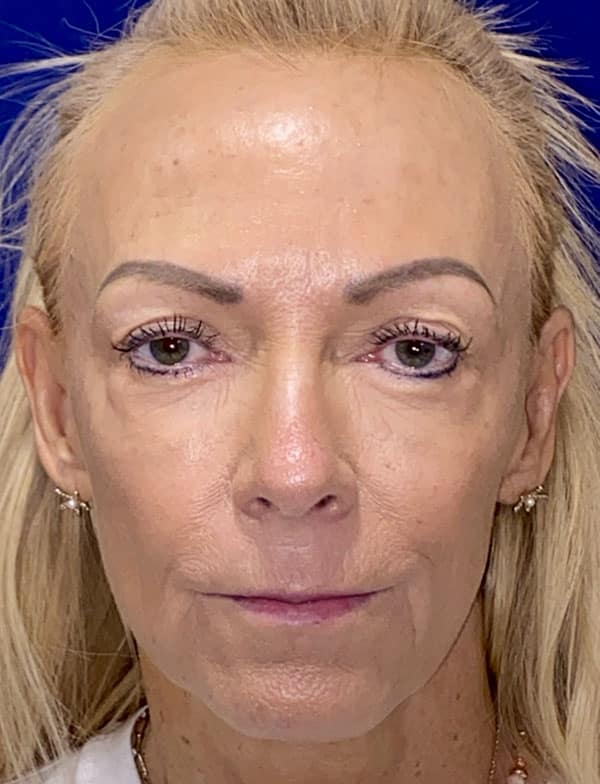Combination Surgeries (eyelid lift and other)