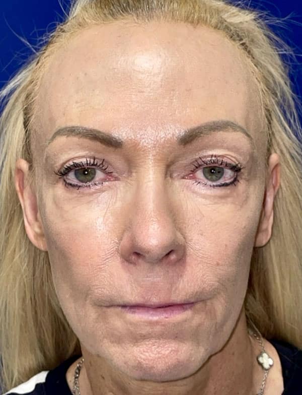 Combination Surgeries (eyelid lift and other)