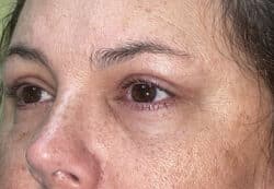 Upper/Lower Lid Blepharoplasty