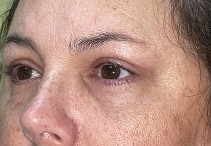 Upper/Lower Lid Blepharoplasty