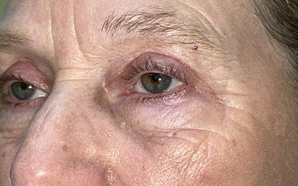 Eyelid Lift (Blepharoplasty/Ptosis Repair)