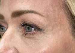 Brow/Forehead Lift