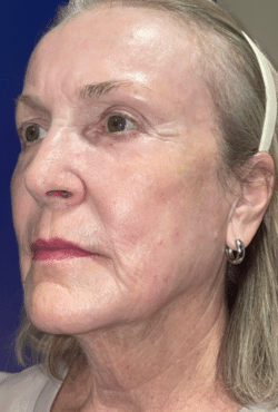 CO2 Laser Resurfacing (wrinkle/line reduction)