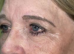 Combination Surgeries (eyelid lift and other)