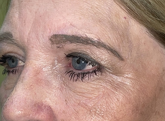 Combination Surgeries (eyelid lift and other)