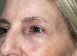 Combination Surgeries (eyelid lift and other)