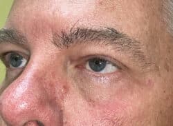 Combination Surgeries (eyelid lift and other)