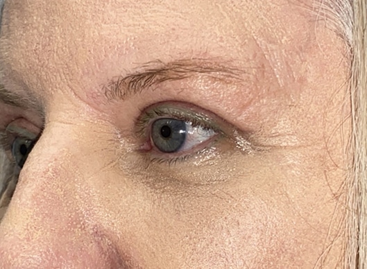 Combination Surgeries (eyelid lift and other)