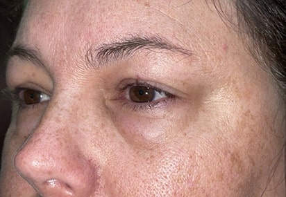 Upper/Lower Lid Blepharoplasty