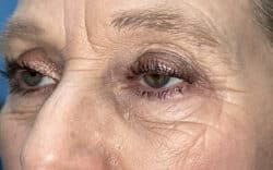 Eyelid Lift (Blepharoplasty/Ptosis Repair)