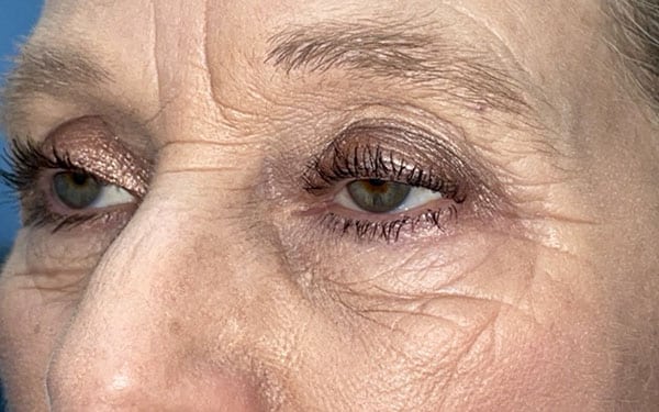 Eyelid Lift (Blepharoplasty/Ptosis Repair)