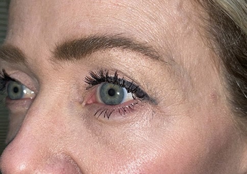 Brow/Forehead Lift