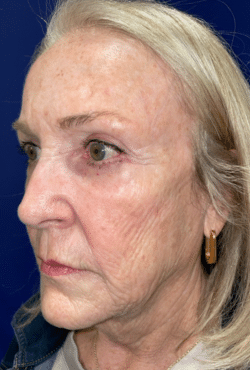 CO2 Laser Resurfacing (wrinkle/line reduction)