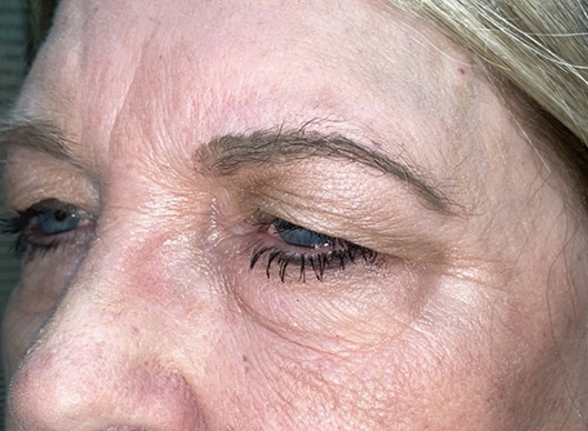 Combination Surgeries (eyelid lift and other)