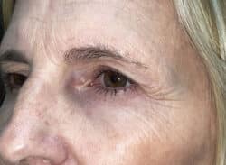 Combination Surgeries (eyelid lift and other)