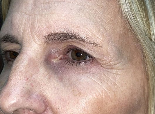 Combination Surgeries (eyelid lift and other)