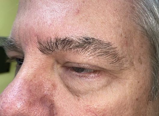 Combination Surgeries (eyelid lift and other)