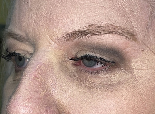 Combination Surgeries (eyelid lift and other)