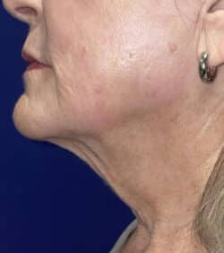 CO2 Laser Resurfacing (wrinkle/line reduction)