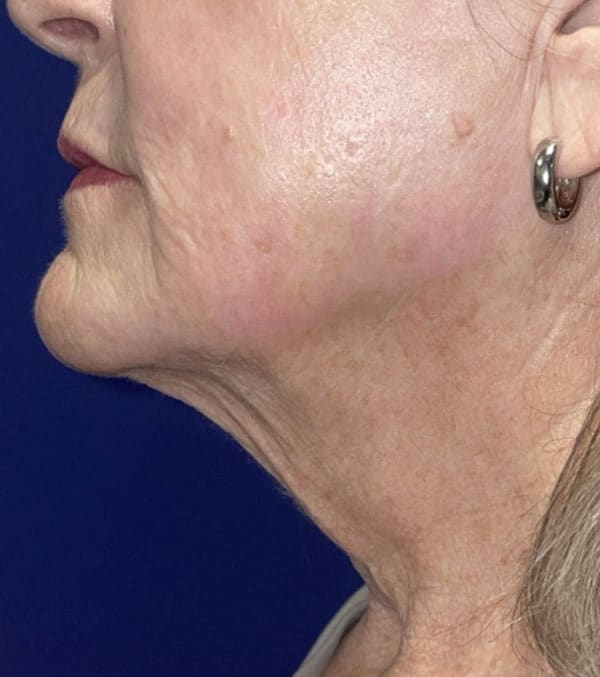 CO2 Laser Resurfacing (wrinkle/line reduction)