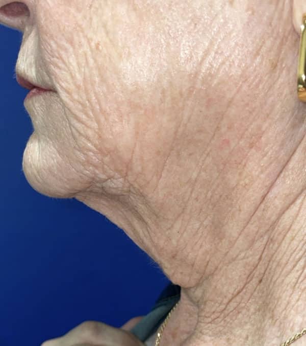 CO2 Laser Resurfacing (wrinkle/line reduction)