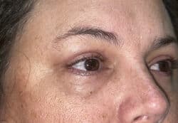 Upper/Lower Lid Blepharoplasty