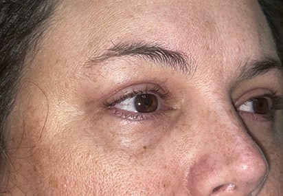 Upper/Lower Lid Blepharoplasty