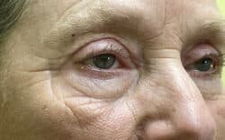 Eyelid Lift (Blepharoplasty/Ptosis Repair)
