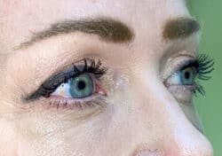 Brow/Forehead Lift