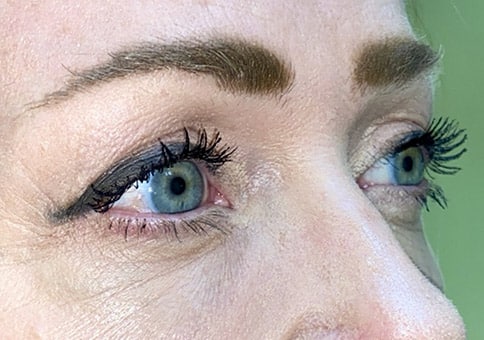 Brow/Forehead Lift