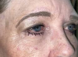 Combination Surgeries (eyelid lift and other)