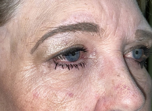 Combination Surgeries (eyelid lift and other)