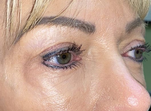 Combination Surgeries (eyelid lift and other)