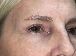 Combination Surgeries (eyelid lift and other)