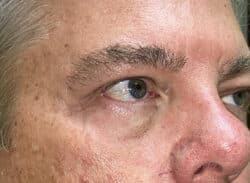 Combination Surgeries (eyelid lift and other)